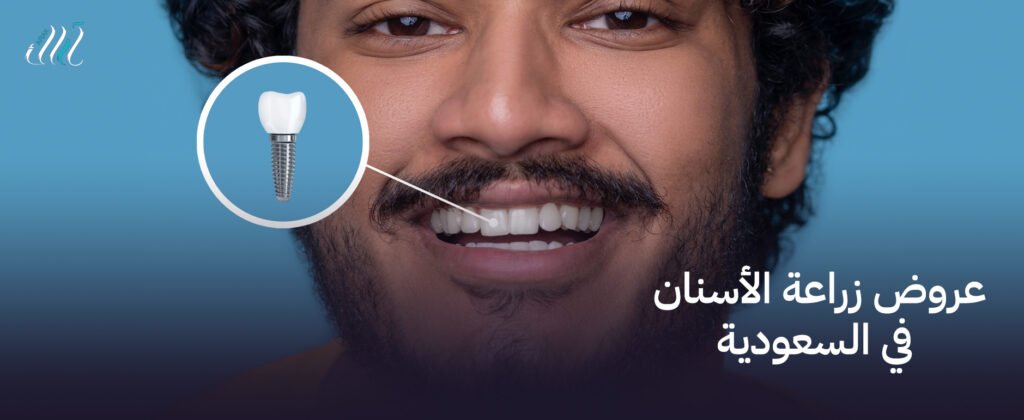 عروض زراعة الأسنان في السعودية ابتسامتك تستحق الأفضل بأسعار مناسبة