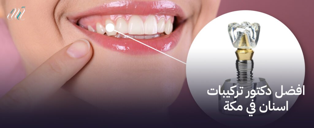 افضل دكتور تركيبات اسنان في مكة | خبرة ومهارة