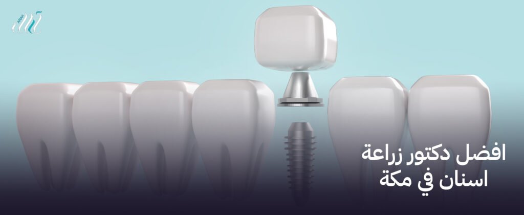 افضل دكتور زراعة اسنان في مكة, زراعة أسنان بأعلى معايير الجودة