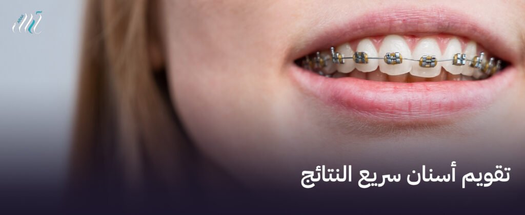 تقويم أسنان سريع النتائج في مكة | ابتسامة رائعة في وقت قياسي