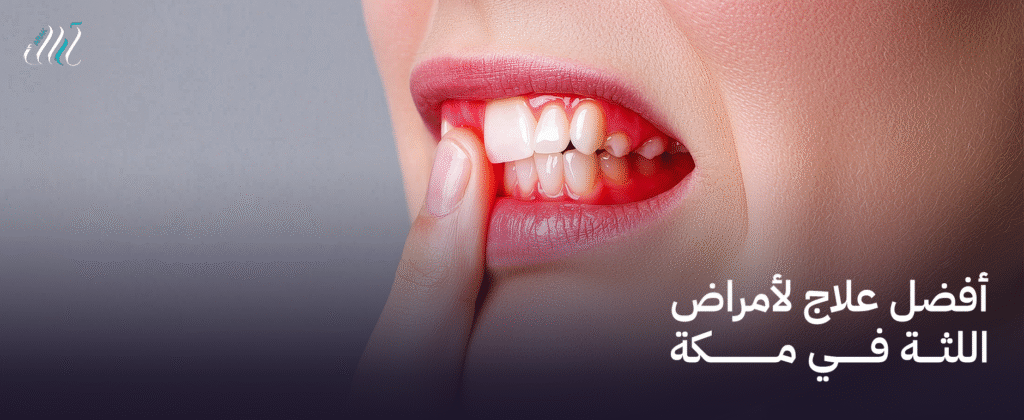 أفضل علاج لأمراض اللثة في مكة – صحتك هي أولويتنا