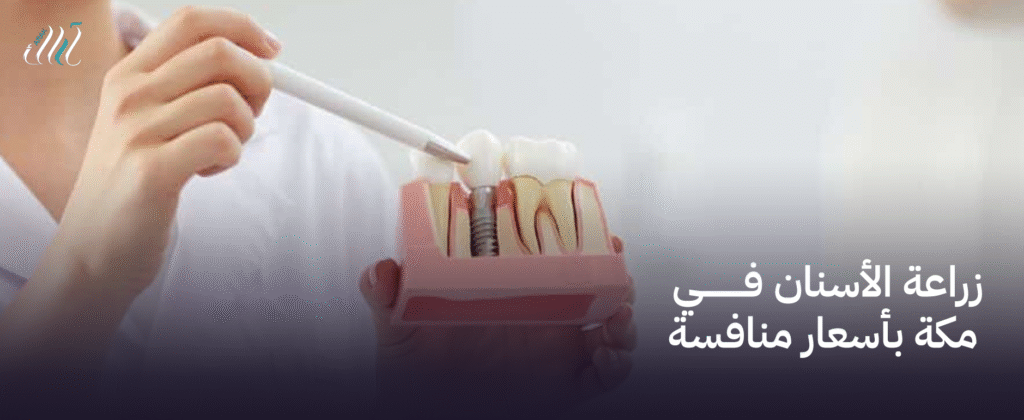 زراعة الأسنان في مكة بأسعار منافسة  | ابتسامة جديدة بتكلفة مناسبة