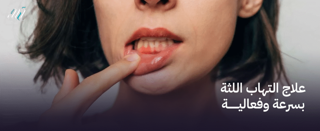 علاج التهاب اللثة بسرعة وفعالية  – استعد لصحة فمك في وقت قصير