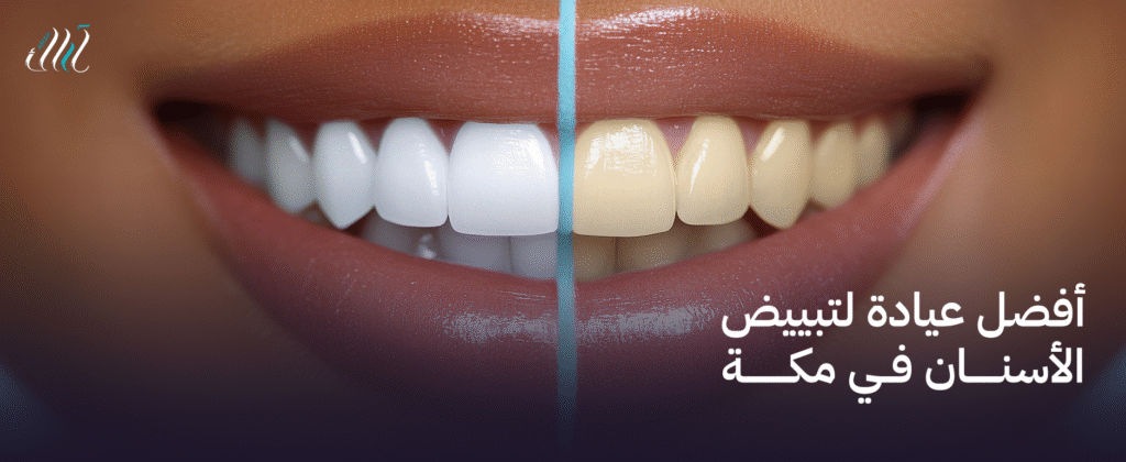 أفضل عيادة لتبييض الأسنان في مكة | ابتسامة مشرقة وجذابة