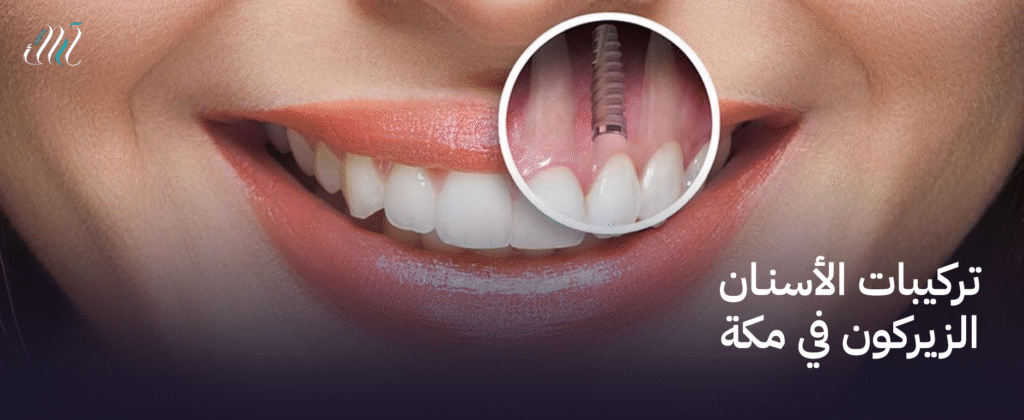 تركيبات الأسنان الزيركون في مكة  | جمال طبيعي ومتانة عالية