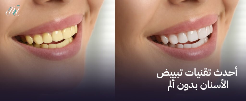 اكتشف أحدث تقنيات تبييض الأسنان بدون ألم – نتائج سريعة وآمنة