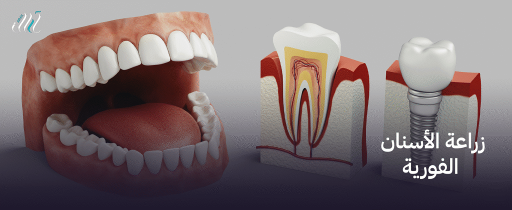 زراعة الأسنان الفورية , استعد لابتسامة جديدة في يوم واحد!