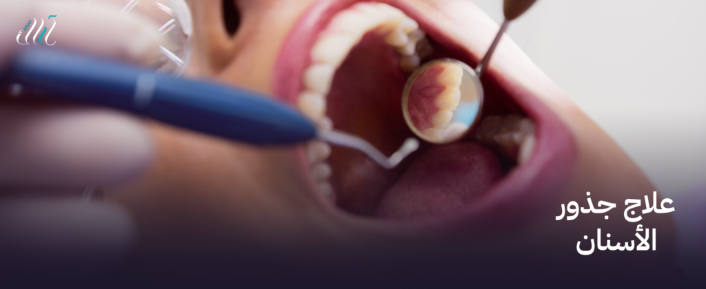 علاج جذور الأسنان بأحدث التقنيات لضمان راحة وديمومة الابتسامة.