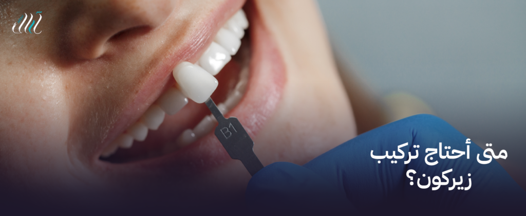 متى أحتاج تركيب زيركون؟ – احصل على استشارة مجانية اليوم