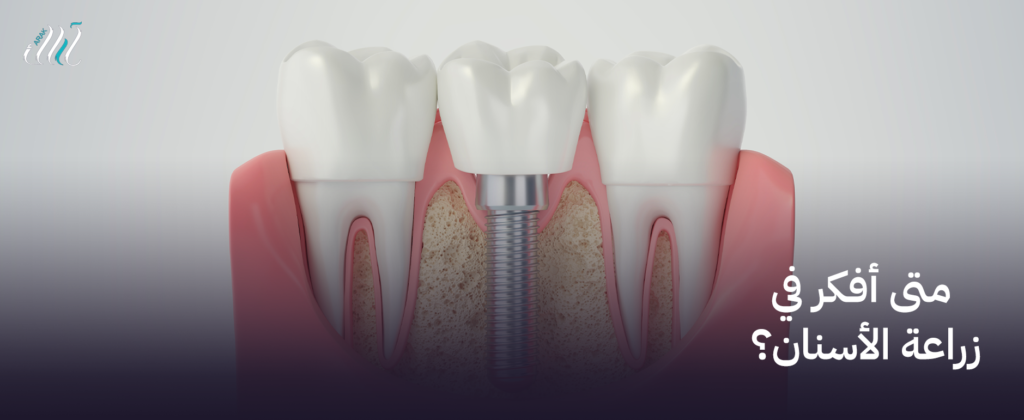 متى أفكر في زراعة الأسنان؟ | الحل الدائم لتعويض الأسنان