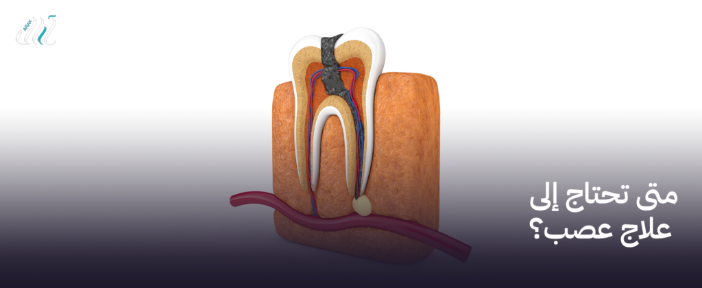 متى تحتاج إلى علاج عصب؟ | أنقذ أسنانك قبل تفاقم الألم