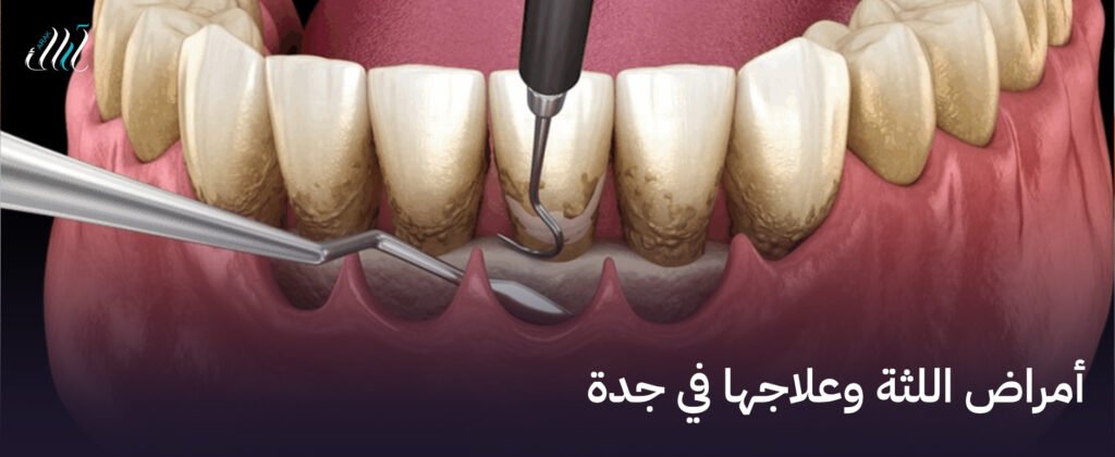 أمراض اللثة وعلاجها في جدة, استعادة صحة فمك بأسلوب احترافي