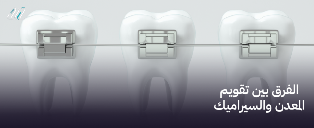 الفرق بين تقويم المعدن والسيراميك, اختر الأنسب لك