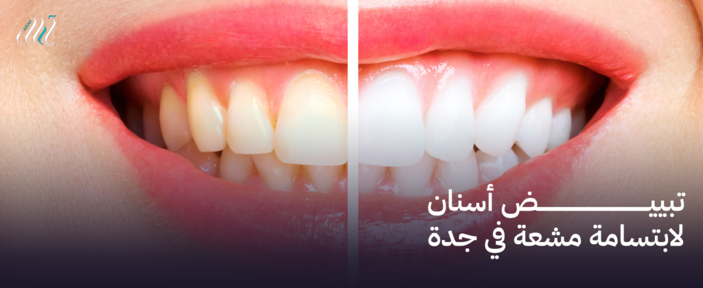تبييض أسنان لابتسامة مشعة في جدة – احصل على أسنان بيضاء وجذابة اليوم
