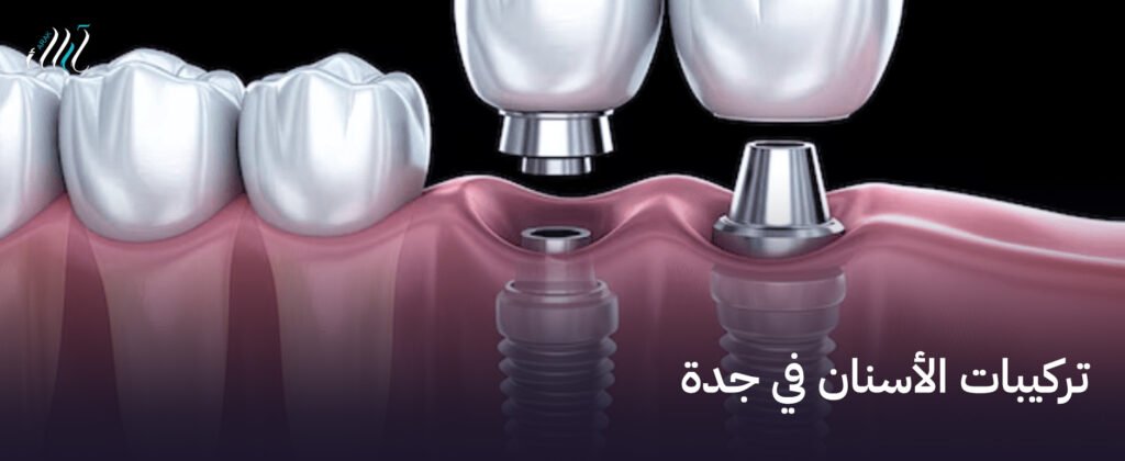 تركيبات الأسنان في جدة, ابتسامة جديدة وأسطورية مع تقنيات مبتكرة