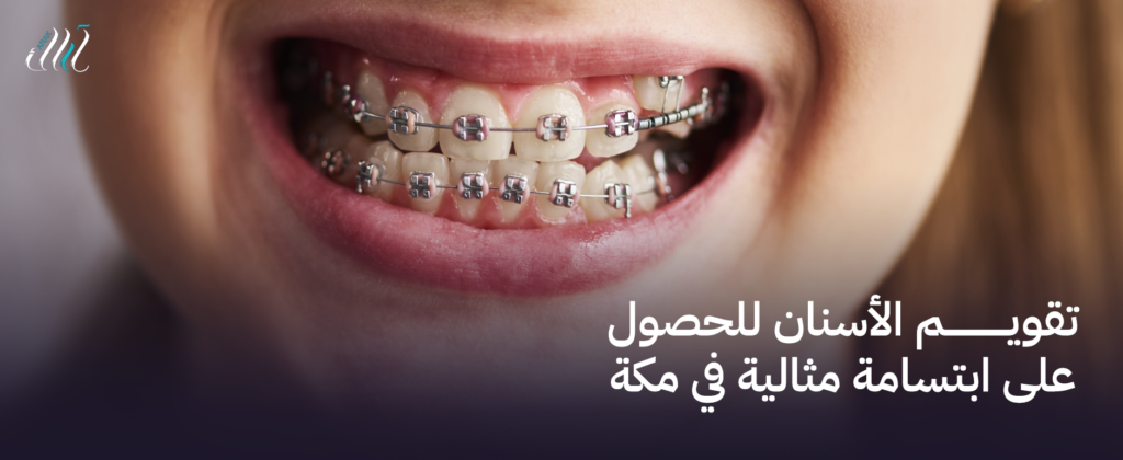 تقويم الأسنان للحصول على ابتسامة مثالية في مكة – نتائج مذهلة الآن