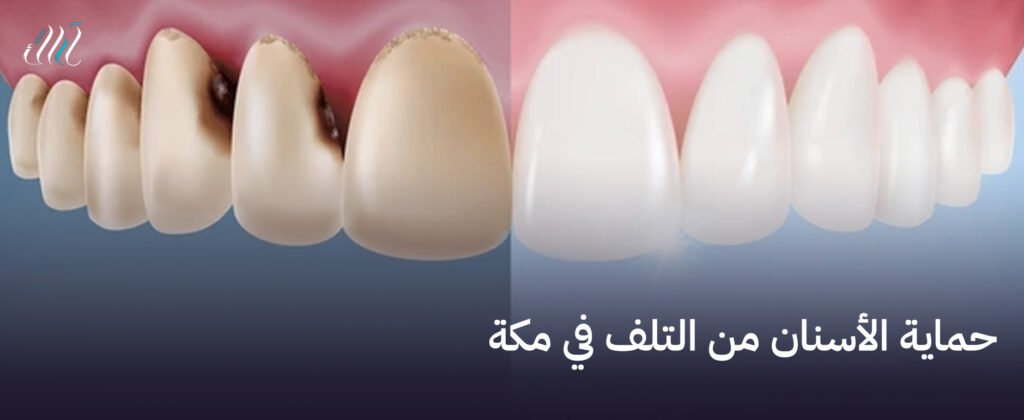 حماية الأسنان من التلف في مكة, حلول متقدمة للحفاظ على أسنانك