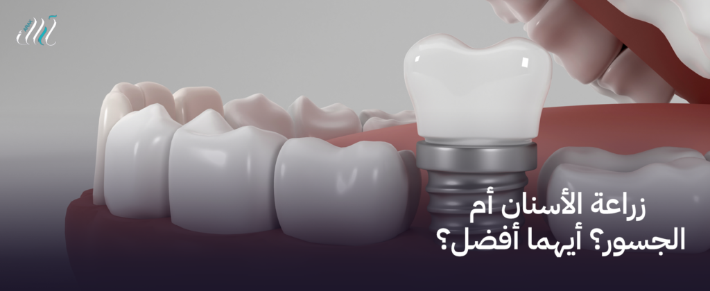زراعة الأسنان أم الجسور؟ أيهما أفضل؟ لصحة فمك.
