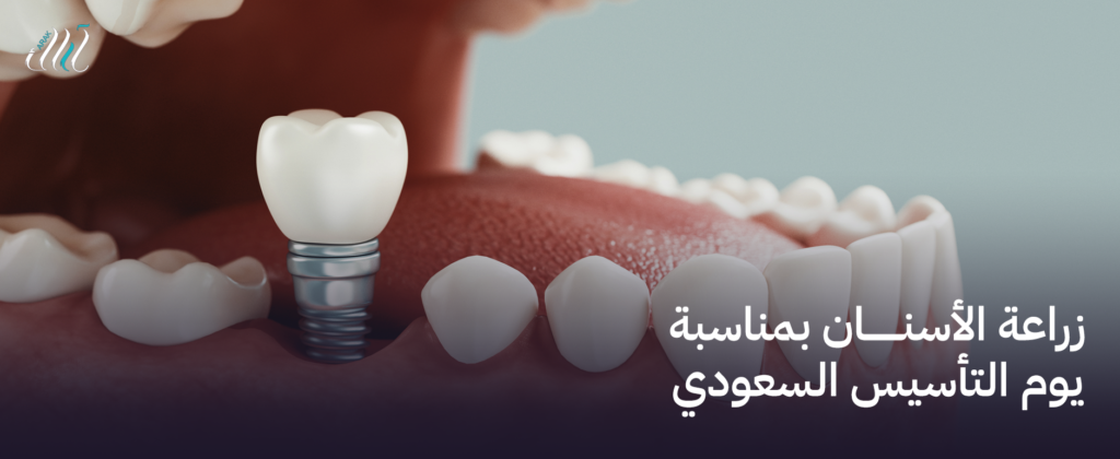 زراعة الأسنان بمناسبة يوم التأسيس السعودي – احصل على ابتسامة جديدة