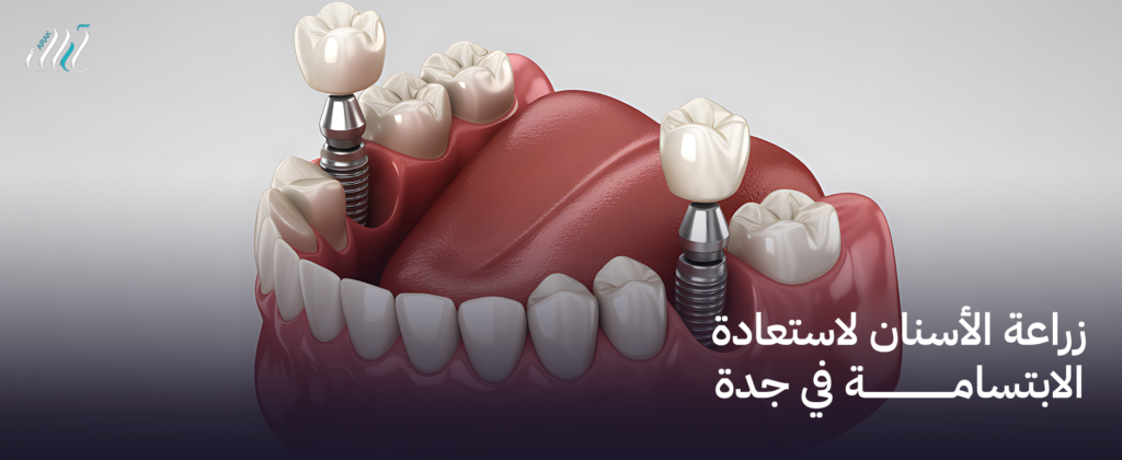 زراعة الأسنان لاستعادة الابتسامة في جدة – ابتسامة جديدة في دقائق