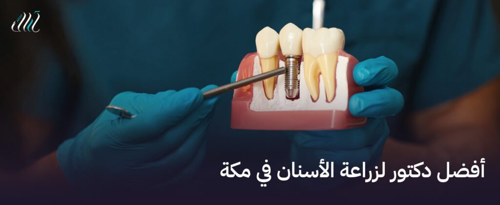 أفضل دكتور لزراعة الأسنان في مكة | زراعة أسنان آمنة وفعالة