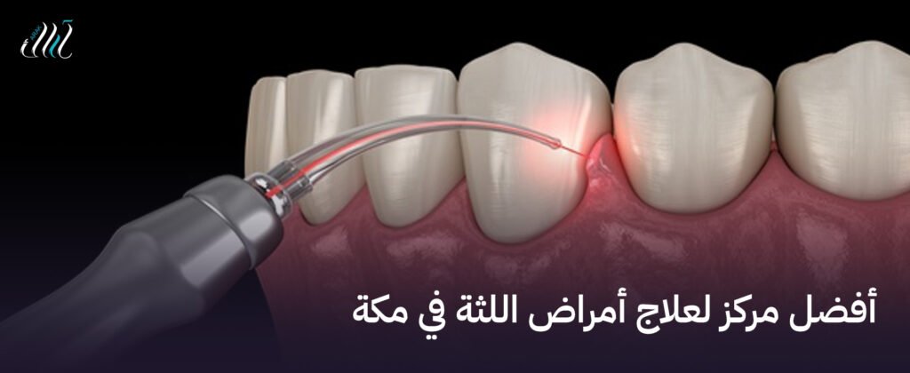 أفضل مركز لعلاج أمراض اللثة في مكة | علاج فعال مع أطباء متخصصين