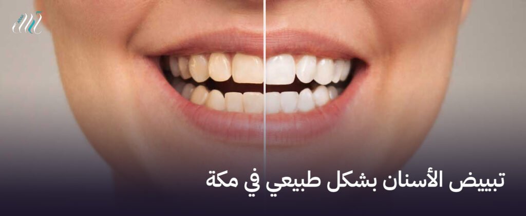 تبييض الأسنان بشكل طبيعي في مكة - ابتسامة مشرقة دون مواد كيميائية