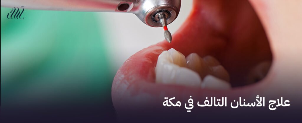 علاج الأسنان التالف في مكة  – استعد لابتسامة مشرقة وخالية من الألم