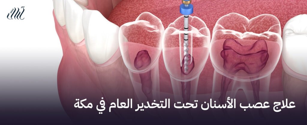 علاج عصب الأسنان تحت التخدير العام في مكة  – راحة تامة وأمان كامل